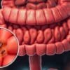 Leaky gut symptoms